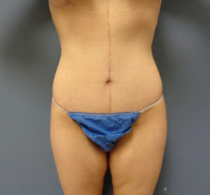 Tummy Tuck with Lift Before & After Pictures in Nashville, TN