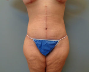 Tummy Tuck with Lift Before & After Pictures in Nashville, TN