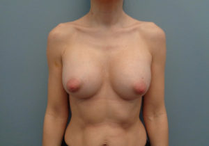 Breast Augmentation Before & After Pictures in Nashville, TN