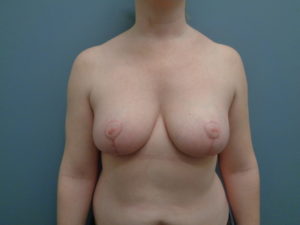 Breast Lift with Lift Before & After Pictures in Nashville, TN