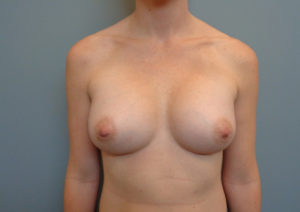 Breast Augmentation Before & After Pictures in Nashville, TN