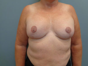 Implant Based reconstruction Before & After Pictures in Nashville, TN