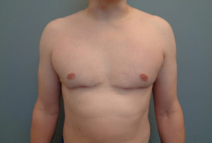 Gynecomastia Before & After Pictures in Nashville, TN