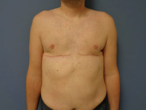 Gynecomastia Before & After Pictures in Nashville, TN