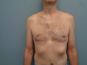 Gynecomastia Before & After Pictures in Nashville, TN