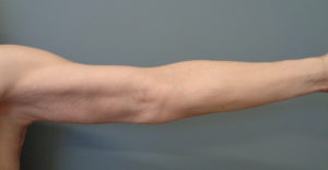 Arm Lift Before & After Pictures in Nashville, TN