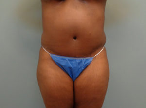 Abdominoplasty Before & After Pictures in Nashville, TN