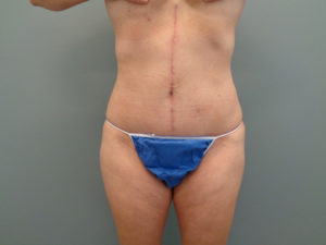 Abdominoplasty Before & After Pictures in Nashville, TN