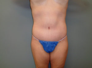 Abdominoplasty Before & After Pictures in Nashville, TN