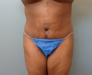 Abdominoplasty Before & After Pictures in Nashville, TN