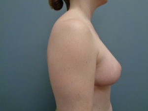 Breast Lift with Lift Before & After Pictures in Nashville, TN