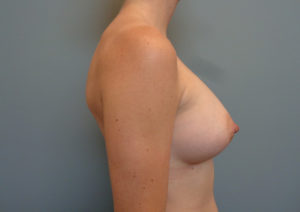 Breast Augmentation Before & After Pictures in Nashville, TN