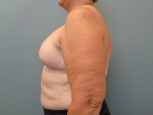 Implant Reconstruction Before & After Pictures in Nashville, TN