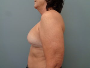 Breast Reconstruction-Implant Based Before & After Pictures in Nashville, TN