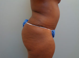 Abdominoplasty Before & After Pictures in Nashville, TN