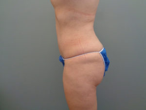 Abdominoplasty Before & After Pictures in Nashville, TN