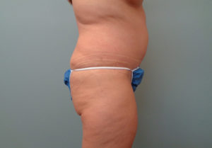 Tummy Tuck Before & After Pictures in Nashville, TN