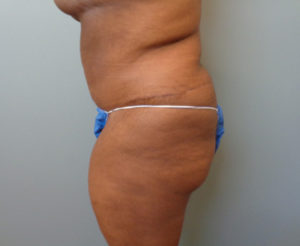 Abdominoplasty Before & After Pictures in Nashville, TN