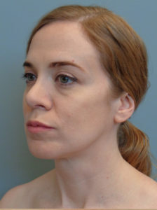 Rhinoplasty Before & After Pictures in Nashville, TN