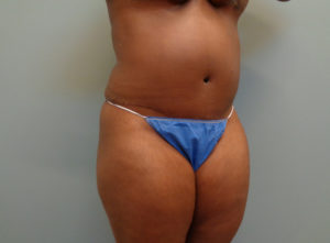 Abdominoplasty Before & After Pictures in Nashville, TN