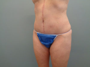 Abdominoplasty Before & After Pictures in Nashville, TN
