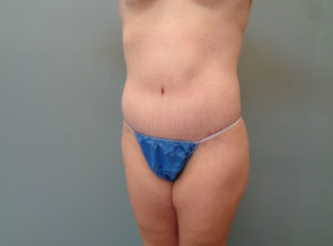 Abdominoplasty Before & After Pictures in Nashville, TN