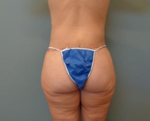 Tummy Tuck with Lift Before & After Pictures in Nashville, TN