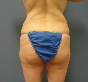 Tummy Tuck with Lift Before & After Pictures in Nashville, TN