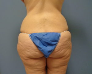 Tummy Tuck with Lift Before & After Pictures in Nashville, TN