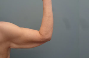 Arm Lift Before & After Pictures in Nashville, TN