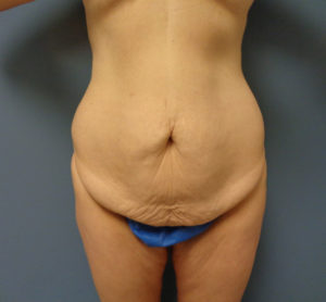 Tummy Tuck with Lift Before & After Pictures in Nashville, TN