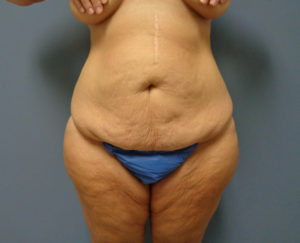 Tummy Tuck with Lift Before & After Pictures in Nashville, TN