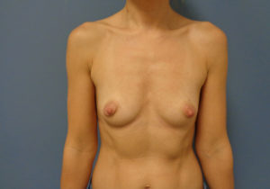 Breast Augmentation Before & After Pictures in Nashville, TN