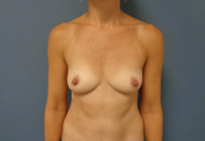 Breast Augmentation Before & After Pictures in Nashville, TN