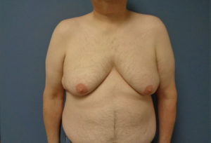 Gynecomastia Before & After Pictures in Nashville, TN