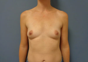 Breast Augmentation Before & After Pictures in Nashville, TN