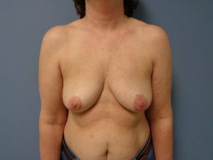 Breast Reconstruction-Implant Based Before & After Pictures in Nashville, TN