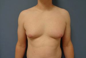 Gynecomastia Before & After Pictures in Nashville, TN