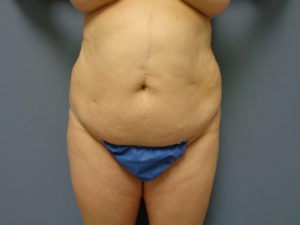 Abdominoplasty Before & After Pictures in Nashville, TN