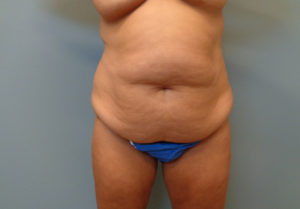 Tummy Tuck Before & After Pictures in Nashville, TN