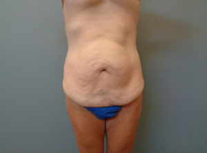 Abdominoplasty Before & After Pictures in Nashville, TN