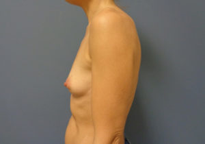 Breast Augmentation Before & After Pictures in Nashville, TN