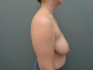 Breast Lift with Lift Before & After Pictures in Nashville, TN