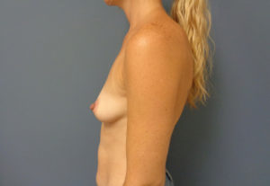 Breast Augmentation Before & After Pictures in Nashville, TN