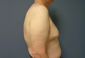 Gynecomastia Before & After Pictures in Nashville, TN