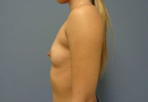 Breast Augmentation Before & After Pictures in Nashville, TN