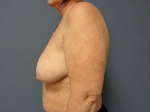 Implant Based reconstruction Before & After Pictures in Nashville, TN