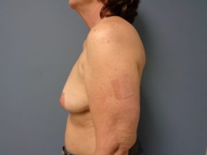 Breast Reconstruction-Implant Based Before & After Pictures in Nashville, TN