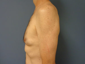 Gynecomastia Before & After Pictures in Nashville, TN