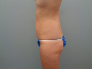 Abdominoplasty Before & After Pictures in Nashville, TN